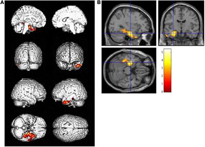 Effect of cognitive reserve on amnestic mild cognitive impairment due to Alzheimer’s disease defined by fluorodeoxyglucose-positron emission tomography